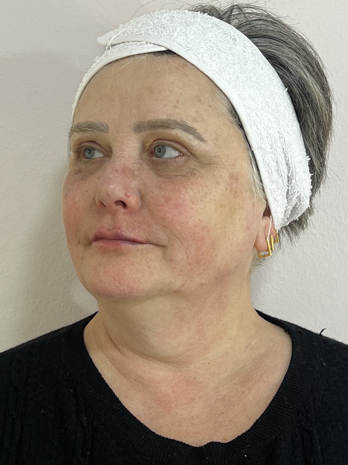 Paciente depois da harmonização facial - vista frontal